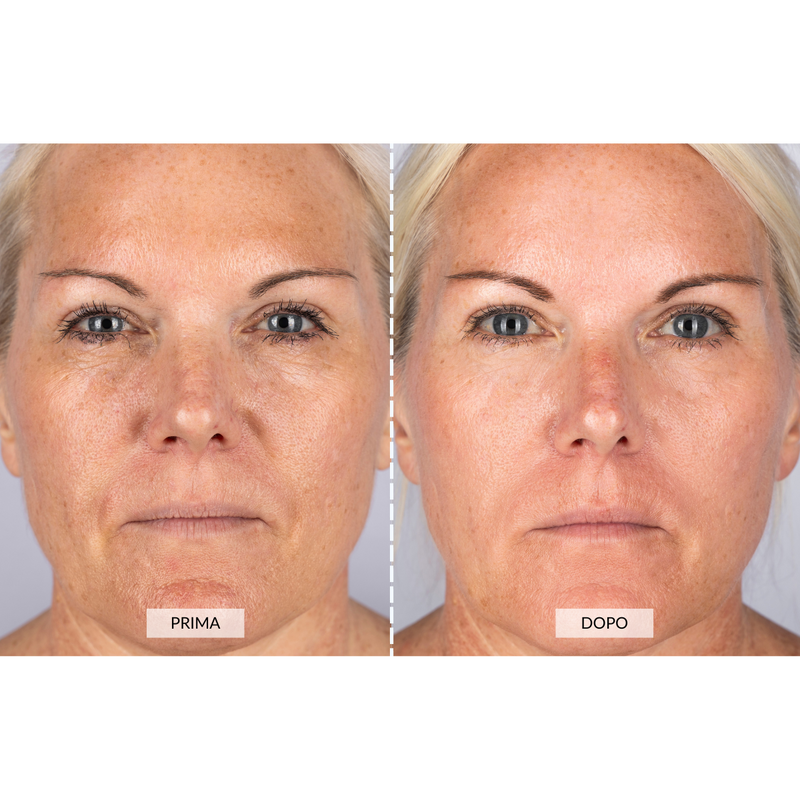 CurrentBody Skin Dispositivo a radiofrequenza per il viso RF Currentbody Skin Nuova