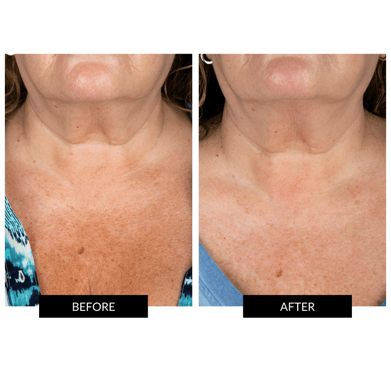 CurrentBody Skin Maschera Collo e Décolleté Vendita