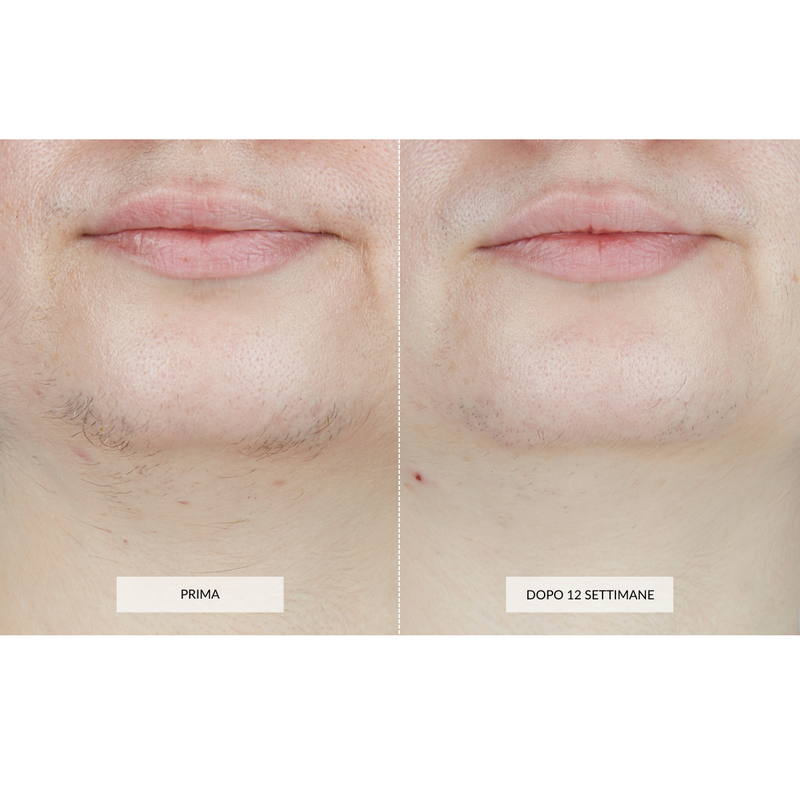 CurrentBody Skin Dispositivo di Epilazione Laser Soddisfazione Garantita