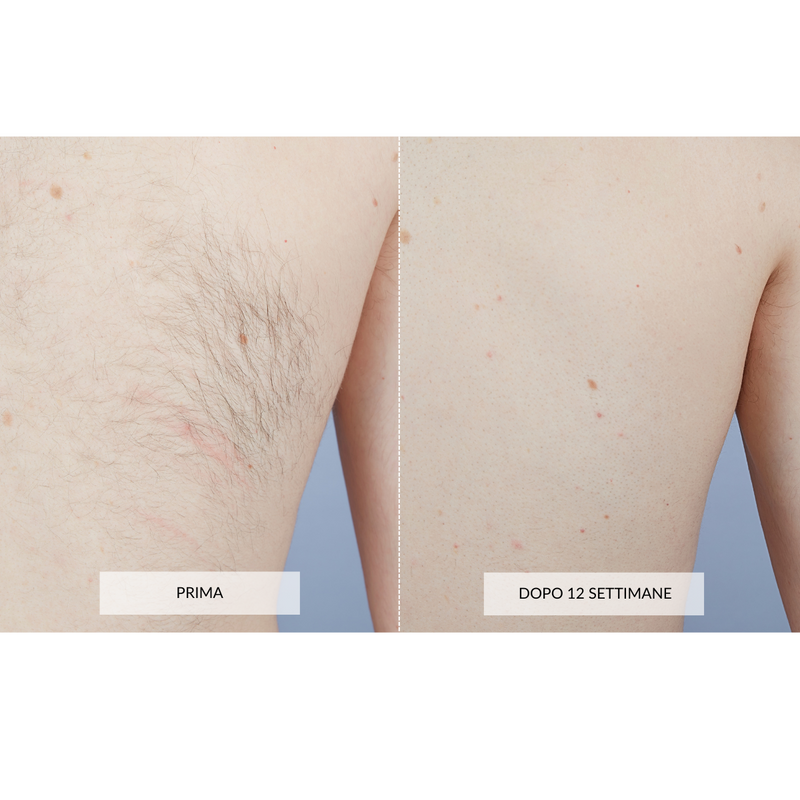 CurrentBody Skin Dispositivo di Epilazione Laser Soddisfazione Garantita