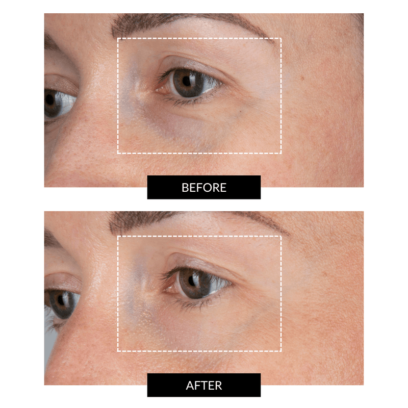 CurrentBody Skin LED Eye Perfector & 5 Eye Hydrogel Masks (del valore di 249€) Sconto