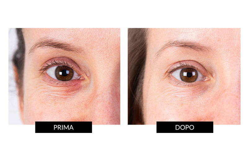 Nira Skin Nira Precision Laser Nuovo