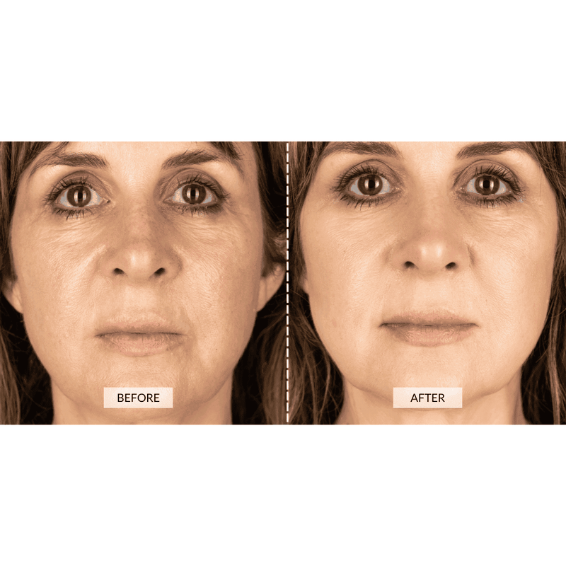 CurrentBody Skin Dispositivo a radiofrequenza RF x Sonia Sélaire Nuova